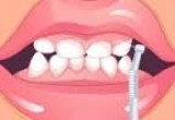 لعبة غسيل الاسنان 2017